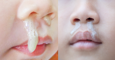 什麼顏色的鼻涕最糟糕 黃鼻涕就是鼻竇炎 兒科權威一次解答 每日健康health