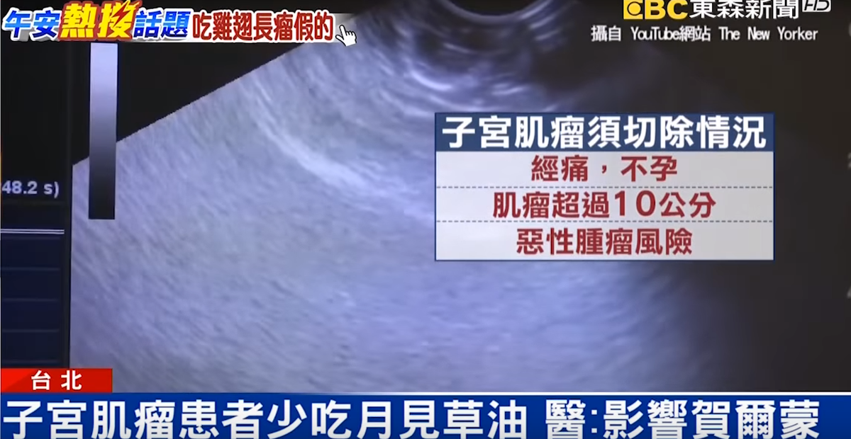 子宮肌瘤