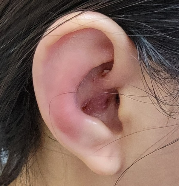▲右耳皮膚出現典型的水皰病灶/陳亮宇醫師 授權提供