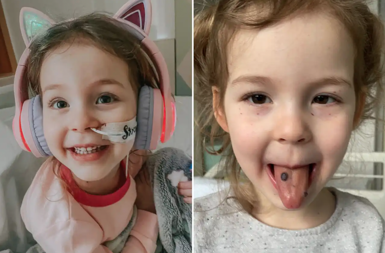 3歲女童舌頭突然「長黑痣」　醫師診斷：致命骨髓血液病